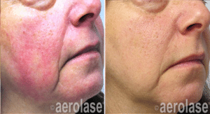 Rosacea1 Pair