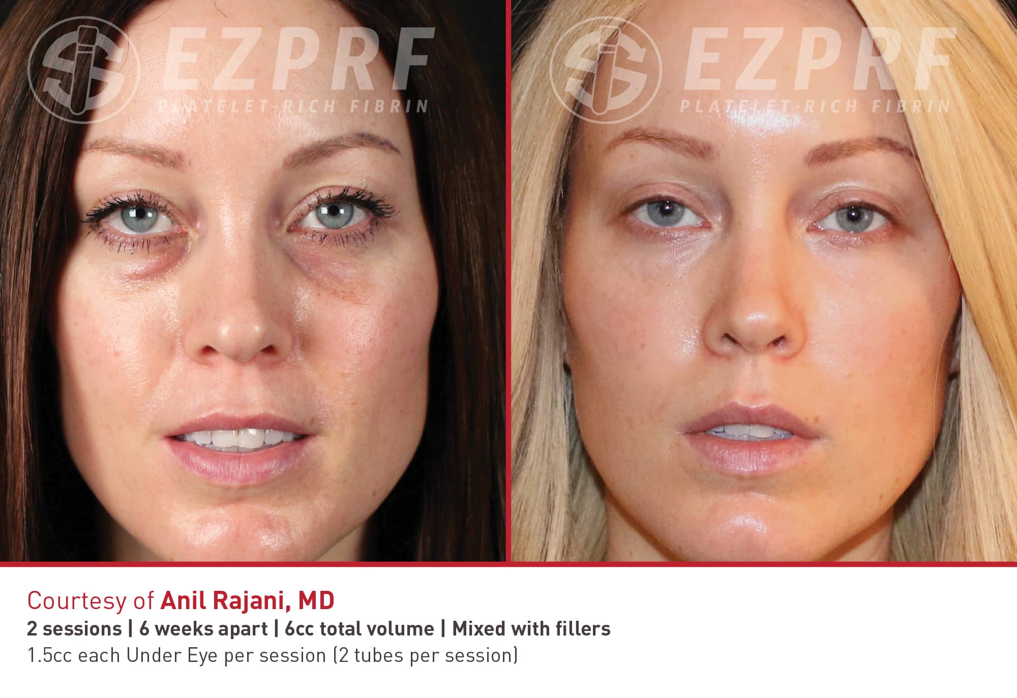 ez-gel-prf-austin-skin-and-wellness