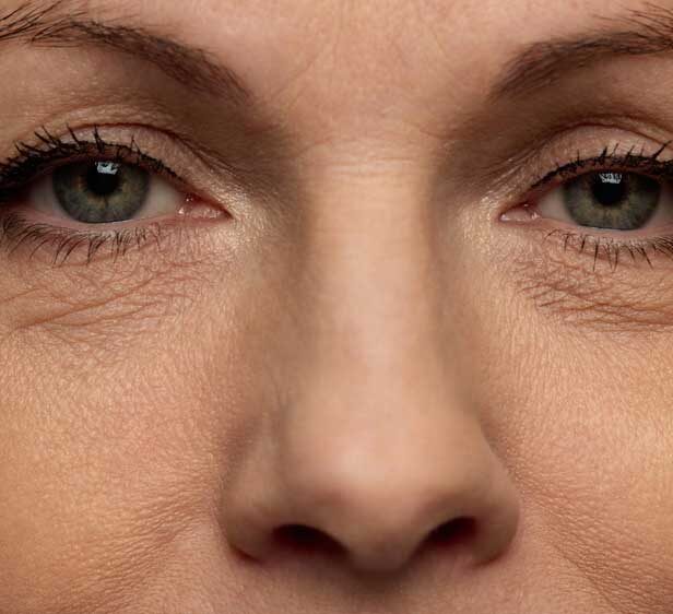 patient with fine line and wrinkles