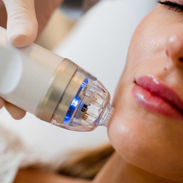 patient getting microneedling treatment